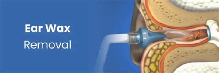 How do you get rid of ear cerumen?