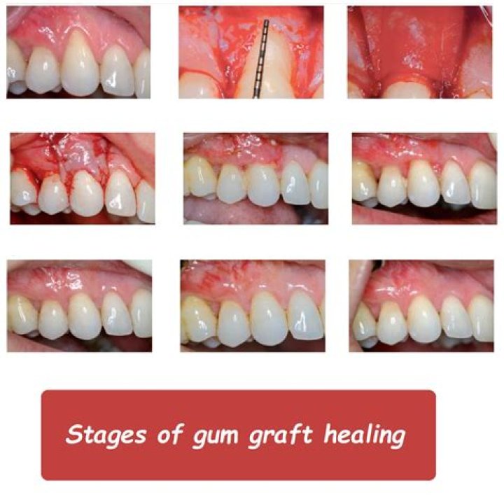 How long does a gingival graft take to heal?