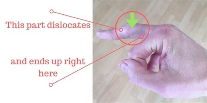 How long should a dislocated finger take to heal?