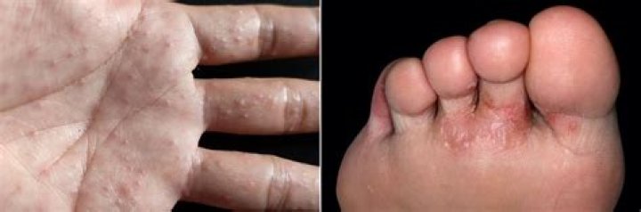 What causes itchy hands and feet with no rash?